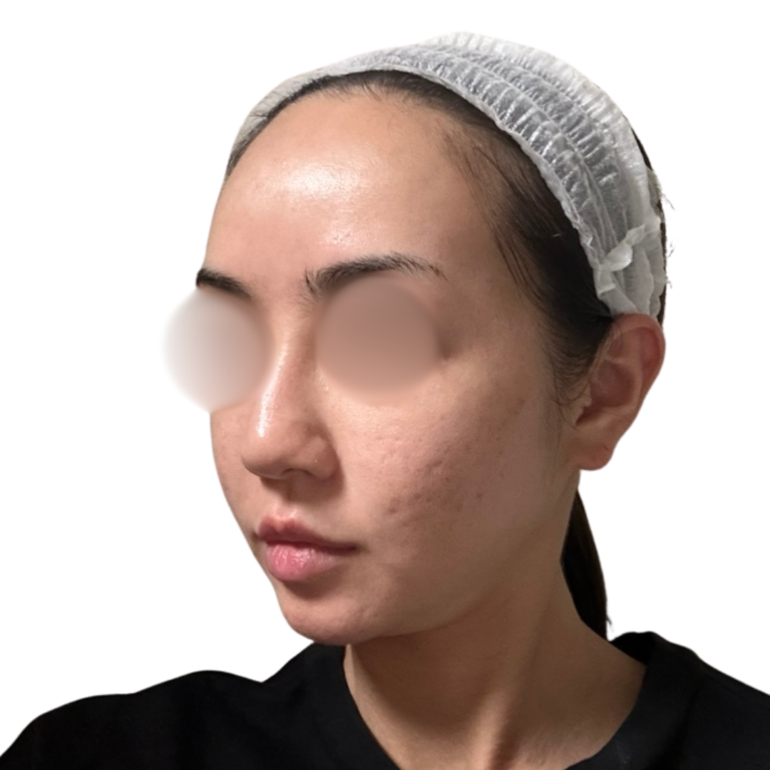 サブシジョン（クレーター治療）